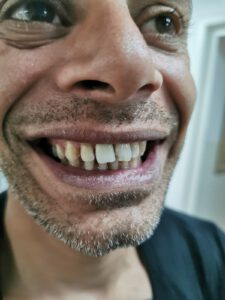 לפני טיפול שיניים