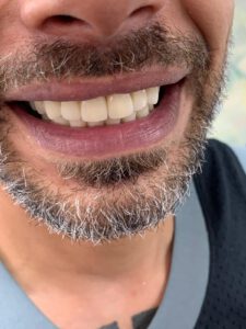 הלבנת שיניים