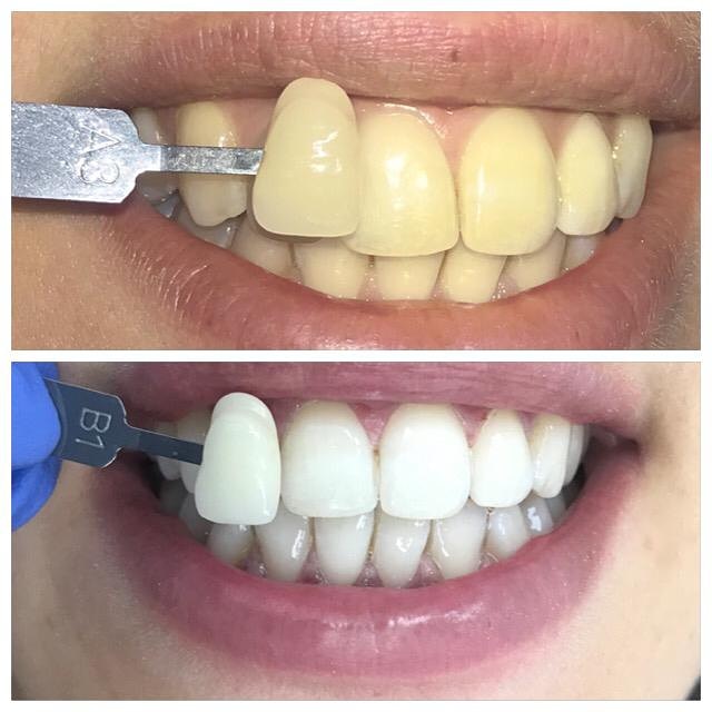לפני ואחרי ניקוי הלבנת שיניים